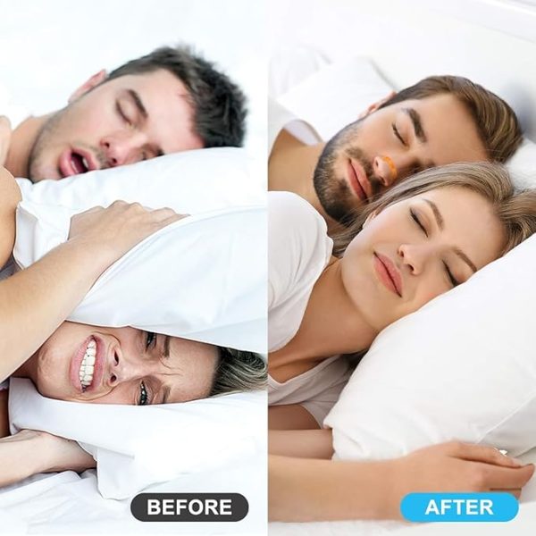 Nasal Breathing Dilator - Image 2
